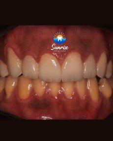 before-after photo emax-veneers