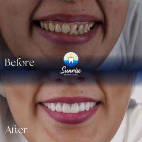 before-after photo emax-veneers