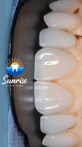 before-after photo emax-veneers