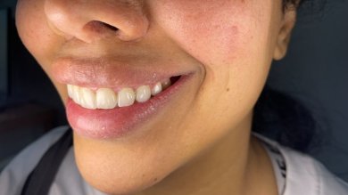 before-after photo emax-veneers