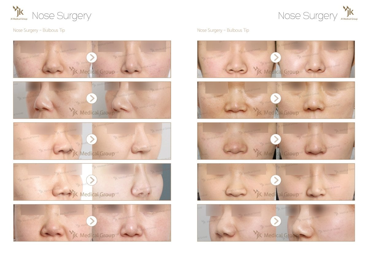 Antes y después de rinoplastia de punta bulbosa en JK Plastic Surgery Center, resultados visibles