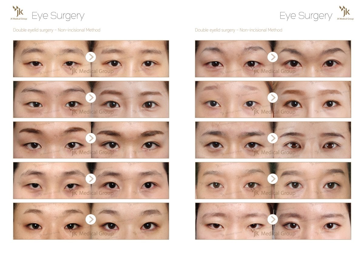 Resultados antes y después de cirugía de párpado doble en JK Plastic Surgery Center, método no incisional