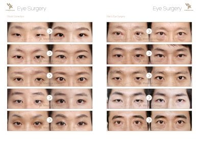 Before and after eye surgery results at JK Plastic Surgery Center, ptosis correction and eyelid lift