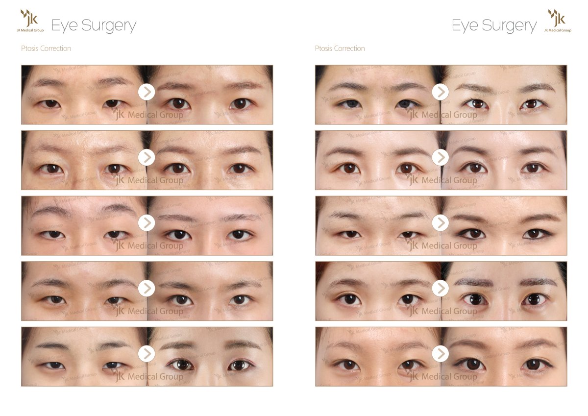 Antes y después de corrección de ptosis en JK Plastic Surgery Center, resultado de párpados mejorados