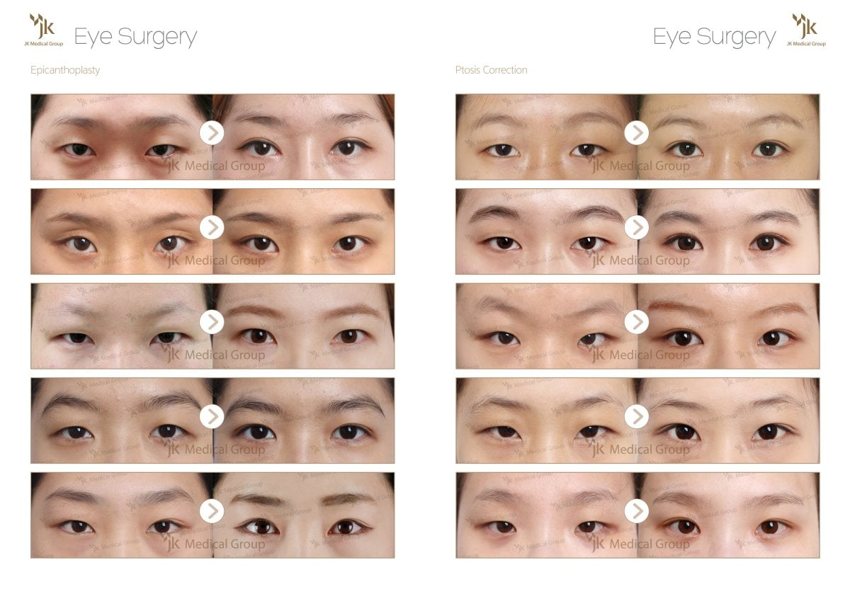 نتائج قبل وبعد جراحة الجفن المزدوج في JK Plastic Surgery Center، تحسين شكل العين