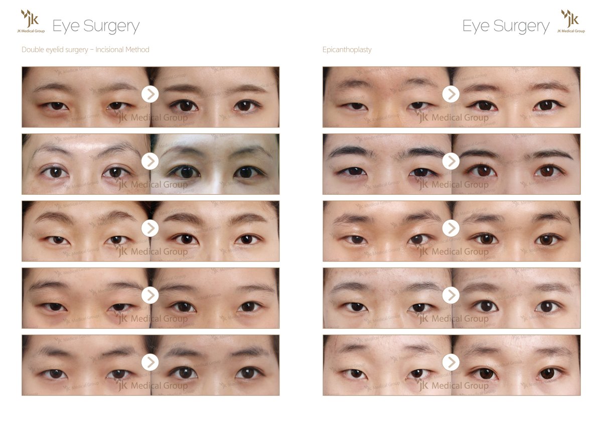 نتائج قبل وبعد جراحة الجفن المزدوج في JK Plastic Surgery Center، تحسين طبيعي للعين