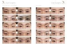 Vorher-nachher-Ergebnisse der Doppellid-OP im JK Plastic Surgery Center, natürliche Augenverbesserung