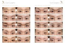 نتائج قبل وبعد جراحة الجفن المزدوج في JK Plastic Surgery Center بطريقة غير جراحية