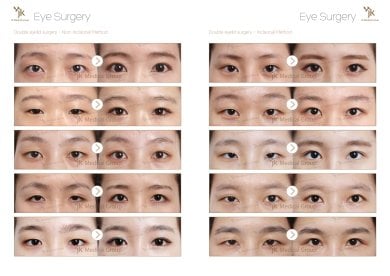 Vorher-nachher-Ergebnisse der Doppellid-OP bei JK Plastic Surgery Center, beide Methoden