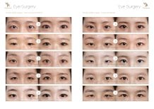 Vorher-nachher-Ergebnisse der Doppellid-OP bei JK Plastic Surgery Center, beide Methoden