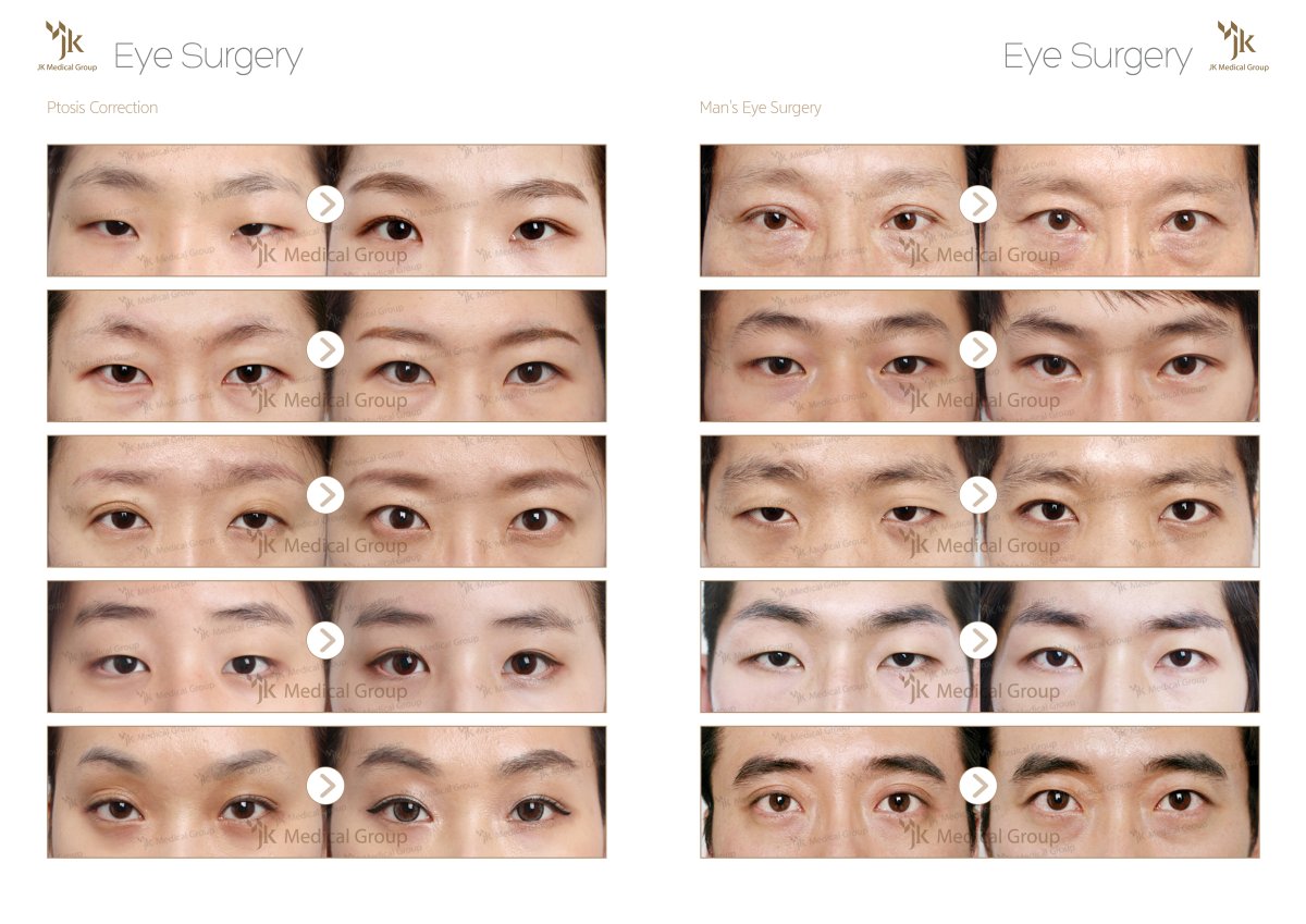 نتائج قبل وبعد جراحة الجفن المزدوج في مركز JK لجراحة التجميل، مظهر عين محسّن