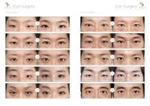 Vorher-nachher-Ergebnisse der Doppellid-OP im JK Plastic Surgery Center, verbesserte Augenpartie