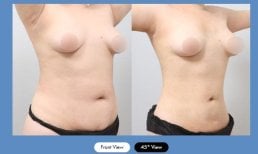 Результати абдомінопластики в AB Plastic Surgery – плаский живіт і кращий контур