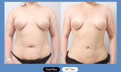 Результати до і після абдомінопластики в AB Plastic Surgery – покращення контуру живота