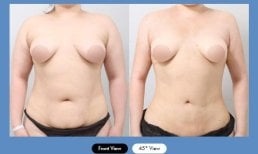 Результати до і після абдомінопластики в AB Plastic Surgery – покращення контуру живота