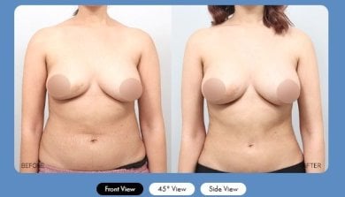 Результати абдомінопластики до і після в AB Plastic Surgery – плаский живіт