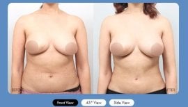 Результати абдомінопластики до і після в AB Plastic Surgery – плаский живіт