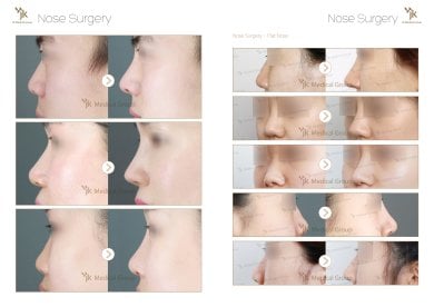 Before and after osteotomy rhinoplasty results at JK Plastic Surgery Center, improved nose profile
