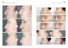 Before and after osteotomy rhinoplasty results at JK Plastic Surgery Center, improved nose profile