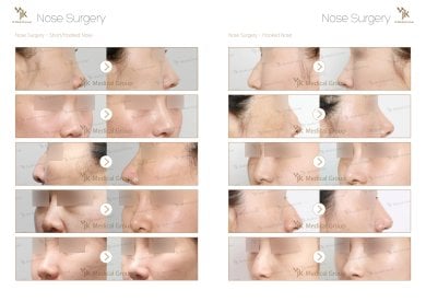 Before and after osteotomy rhinoplasty results for short and hooked nose at JK Plastic Surgery Center
