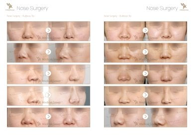 Before and after osteotomy rhinoplasty for bulbous tip at JK Plastic Surgery Center results