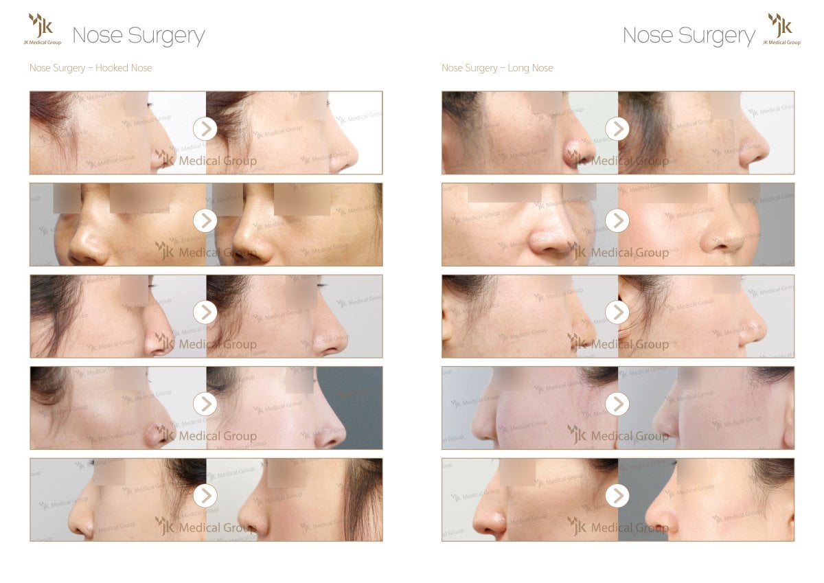 Resultados antes y después de rinoplastia osteotomía para nariz ganchuda y larga en JK Plastic Surgery Center