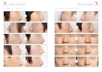 Before and after osteotomy rhinoplasty results for men at JK Plastic Surgery Center, nose reshaping