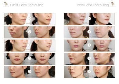 Before and after facial bone contouring results at JK Plastic Surgery Center, jawline reshaping
