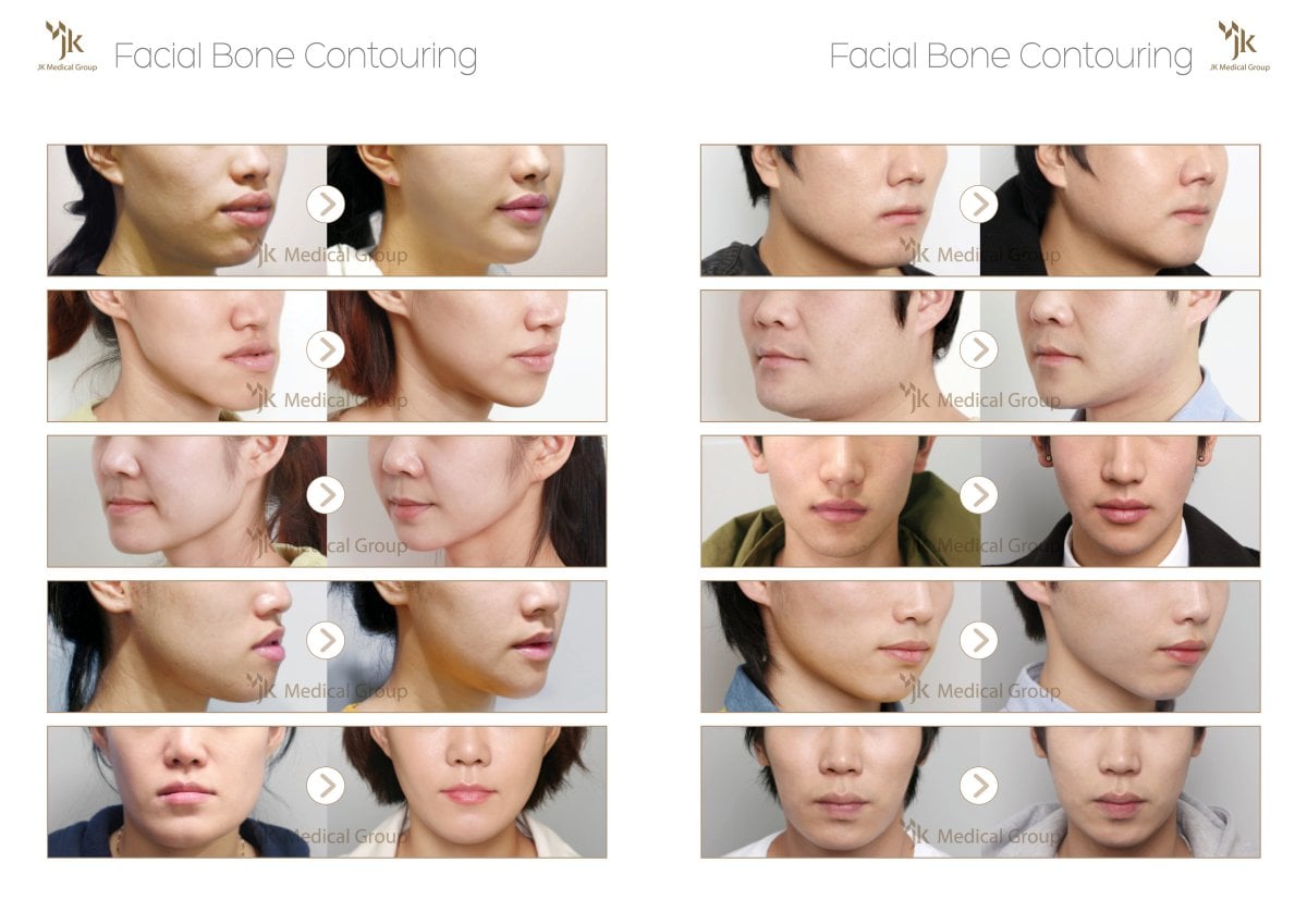 Resultados de contorno óseo facial antes y después en JK Plastic Surgery Center, remodelación de mandíbula