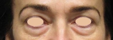 Poches sous les yeux avant blépharoplastie à Altos Clinic, résultat de correction des paupières