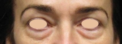 Poches sous les yeux avant blépharoplastie à Altos Clinic, résultat de correction des paupières