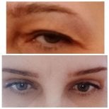 Avant et après blépharoplastie à Altos Clinic – correction des paupières, regard rajeuni