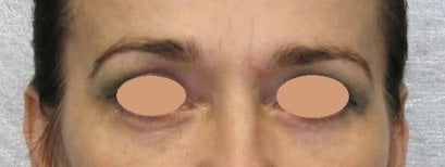 Résultat de blépharoplastie à la clinique Altos – amélioration des paupières