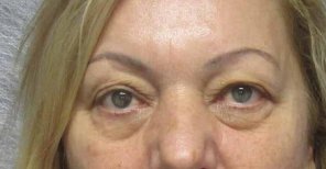 Avant blépharoplastie à Altos Clinic, poches sous les yeux et paupières tombantes visibles