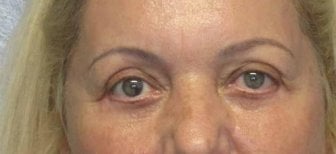 Avant blépharoplastie à Altos Clinic, paupières tombantes et poches sous les yeux