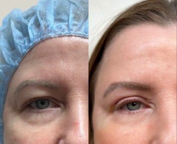 Résultats avant/après blépharoplastie à Altos Clinic – correction des paupières