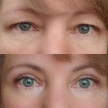 Résultats avant et après blépharoplastie à Altos Clinic – correction des paupières rajeunissante