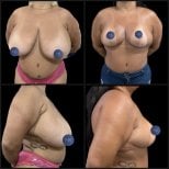 Résultats avant/après lifting mammaire chez Dr. Michel Salameh - Chirurgie esthétique