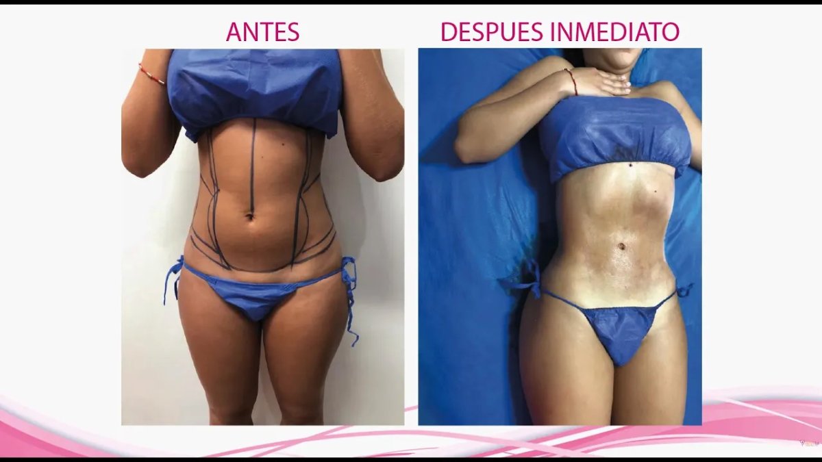 Resultados de liposucción antes y después: cintura definida y abdomen más plano