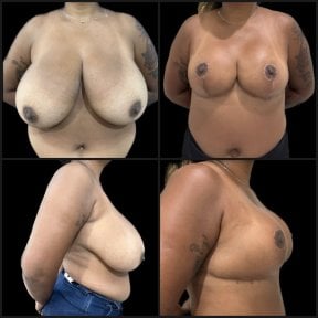 Résultats avant/après lifting mammaire chez Dr. Michel Salameh - Chirurgie esthétique