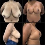 Résultats avant/après lifting mammaire chez Dr. Michel Salameh - Chirurgie esthétique