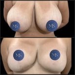 Résultats avant/après lifting mammaire chez Dr. Michel Salameh - Plastic And Aesthetic Surgery