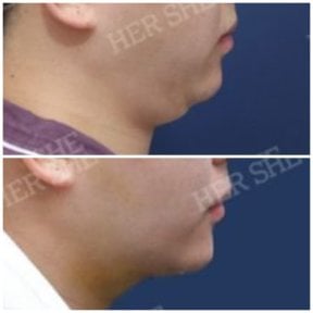 before-after photo liposuction