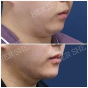 before-after photo liposuction