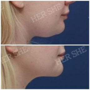 before-after photo liposuction