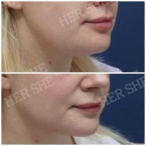 before-after photo liposuction