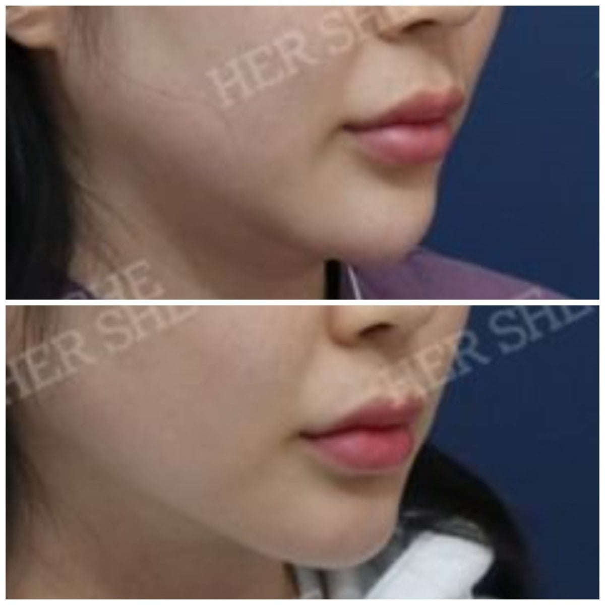 before-after photo