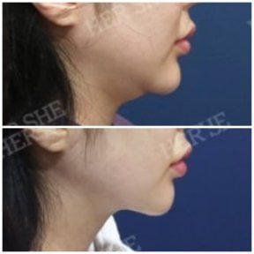 before-after photo liposuction