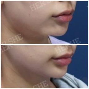before-after photo liposuction