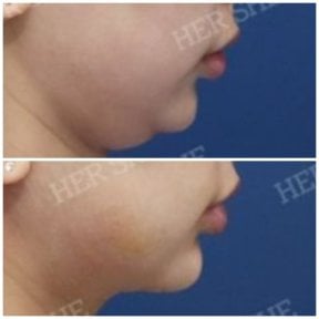 before-after photo liposuction